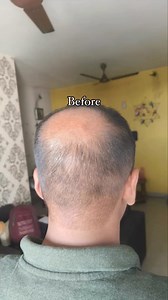 472K views · 84 comments | Wave goodbye to hair fall. Transform your hair care routine with Nanaji's time-tested Ayurvedic formula!  Say goodbye to harsh chemicals and embrace a natural solution for prevention & regrowth. Herbal Ingredients Cruelty Free No Toxins 調Made in house Try Keshpallav today #NaturalHairCare #AyurvedicSolution #HealthyHairJourney. Shop now! | AvimeeHerbal.India | Facebook