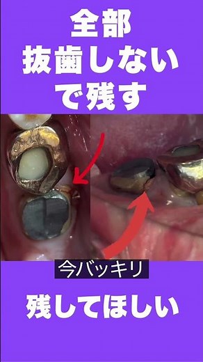 奥歯が割れた 欠けた 破折 抜歯しないで残す治療法 保険適応 虫歯が痛い 埼玉 大宮 歯医者 鈴木歯科医院 さいたま市 歯医者