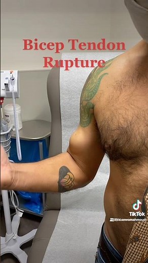 Bicep Tendon Rupture