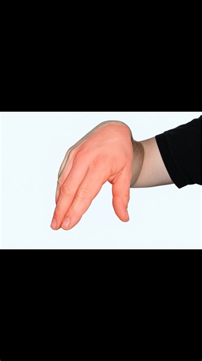 The flick sign evaluates for carpal tunnel syndrome. When asked, “What do you do with your hands when the symptoms are at their worst?”, the patient may demonstrate a flicking motion of the wrist and hand, resembling the action used to shake down a thermometer. This characteristic movement is often an instinctive response to relieve discomfort or tingling sensations in the hand and wrist. One study found sensitivity 93%, specificity 96%! Read: https://wikism.org/Flick_Sign Watch: https://www.you