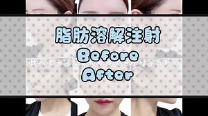 スタッフが脂肪溶解注射を打ってみました💎#ビーラインクリニック #美容外科 #美容皮膚科 #プチ整形 #脂肪溶解注射