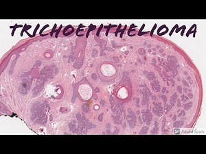 Trichoepithelioma 101