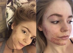 987K views · 5.1K reactions | Cuenta su secreto para acabar con el acné | Yahoo En Español | Facebook