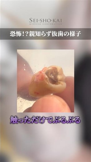 虫歯でぶよぶよになった親知らずを抜歯 #歯医者 #矯正歯科 #虫歯
