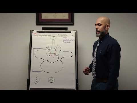 Q and A - pars interarticularis fracture