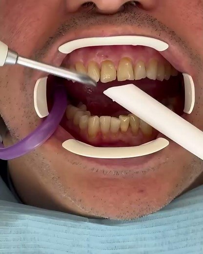 IVENEER spoon technique "cut wings" with Kuraray injectable composite