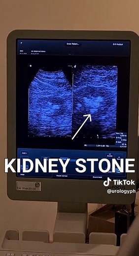 How ESWL (Extracorporeal Shockwave Lithotripsy) works? - It uses high-energy shock (pressure) waves to break up stones. - These waves are aimed at kidney stones to break them into smaller pieces by using robust and focused energy waves to shatter the stones. - Tiny pieces of the stones can then move through your urinary tract and out of your body more easily. - Kidney stones are rock-like masses that form when you have high levels of certain substances in your urine.