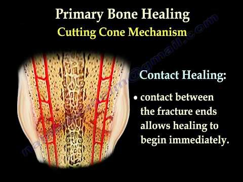 Fracture Healing Part 2 - Everything You Need to Know - Dr. Nabil Ebraheim