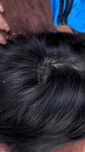 Effective Dandruff Removal for Dry Scalp and Big Flakes