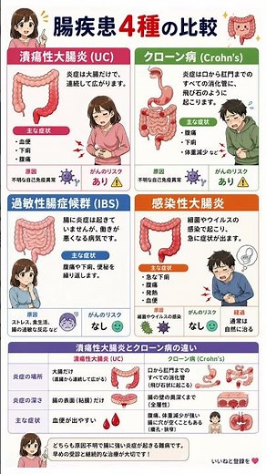 その腹痛、どの病気？腸疾患4種（UC・クローン病・IBS・感染性）の違いとリスクを徹底解説｜がんのリスクや症状の見極め方を専門的にガイド！