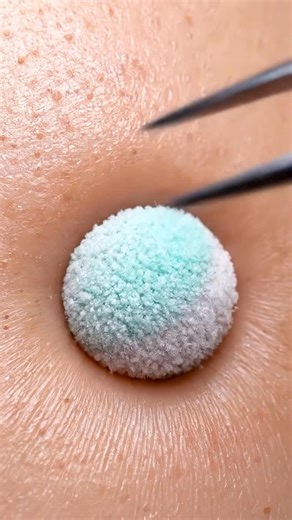 The most satisfying pimple pops today 💥 #ASMR | Vexx Labss