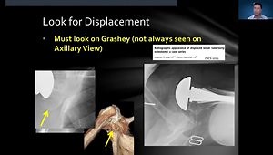 Top 5 Reasons Why Lesser Tuberosity Osteotomy Is the Gold Standard