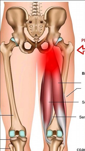Inflammation of the Hamstring Tendon Exercises (Hamstring Tendinopathy)