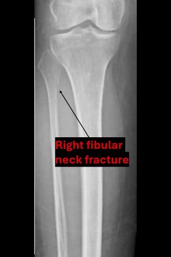 Fibula neck fracture
