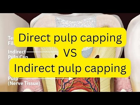DIRECT VS INDIRECT pulp capping