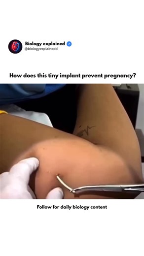 BIOLOGY | MEDICAL EXPLAINED on Instagram: "The contraceptive implant (Nexplanon®) is a small, matchstick-sized rod placed just under the skin of the upper arm by a trained healthcare provider. It provides continuous pregnancy prevention for up to 3 years, without requiring daily attention. 🔬 How it works • Releases a steady, low dose of the hormone progestin • Prevents ovulation (no egg is released) • Thickens cervical mucus, blocking sperm • Thins the uterine lining, making pregnancy unlikely 