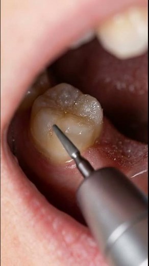 Watch a Missing Tooth Get a Perfect Bridge! 🦷 #Shorts #dentist #toothcraft