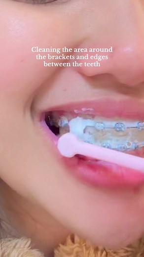 Effective Teeth Care with Braces: Brushing and Flossing Routine