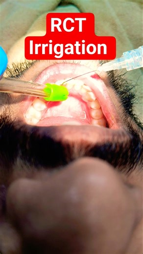 #RCT #Root Canal Treatment #Root canal irrigation #dental treatment #a way to save tooth is RCT