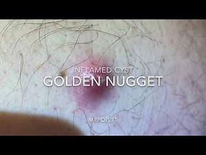 Golden nugget inflamed cyst. Cyst pop. Cyst removal. Cyst excision. MrPopZit.