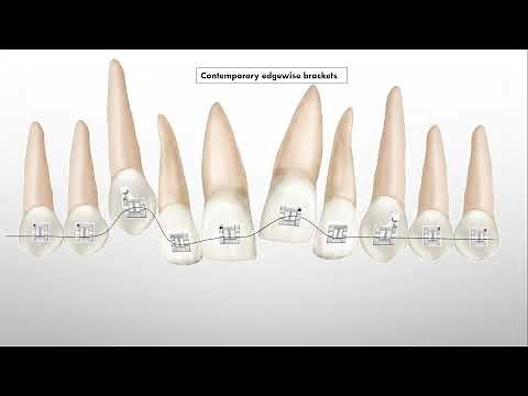 Second order (Tip) bends