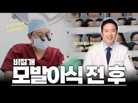 Real-life success stories of non-incisional hair transplants! Apgujeong Monara Dermatology!