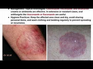 Ringworm of the Scalp, Body & Feet | Diagnosis & Treatment in Dermatology