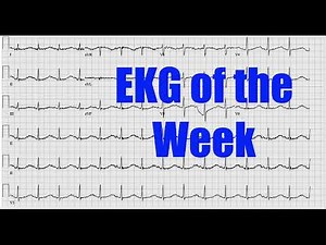 EKG of the week #6