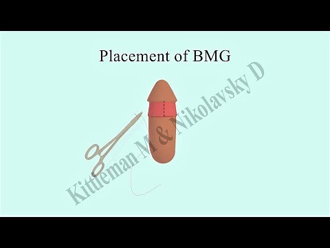new treatment for recurrent penile adhesions- the buccal "belt" graft (patient information)