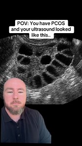Drop a comment if your ultrasound ever looked like the ones in this video 👀And did anyone actually explain to you what it meant?Polycystic ovaries are one of the most common symptoms of PCOS — and probably the most misunderstood. Thanks to the name Polycystic Ovary Syndrome, many assume they’re one and the same.But here’s the truth: PCOS and polycystic ovaries are not the same thing.Polycystic ovaries are what’s seen on an ultrasound (like the clips you’re watching). PCOS is a full-body, hormon