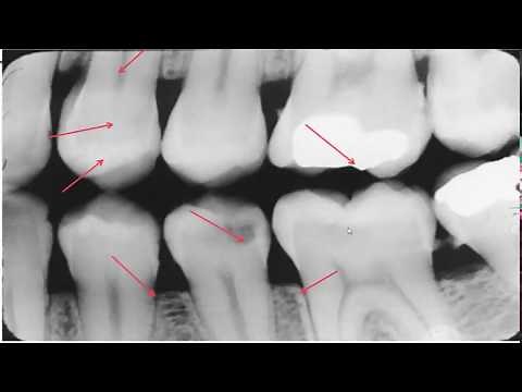 Interprétation du BITEWING : rétro coronaire