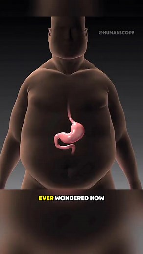 Sleeve Gastrectomy Procedure (3D Animation) #sleevegastrectomy #gastrectomy #weightloss #weightlosssurgery #stomachsurgey | PurelyFit