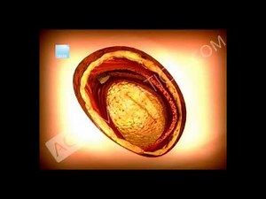 Nefrectomía Abierta