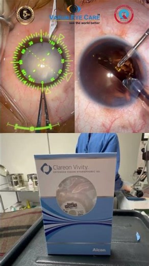 AI Assisted Cataract Surgery with Clareon Vivity Premium Lens at Varun Eye Care
