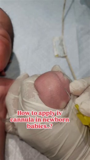 @nicu_nursing_work on Instagram: "Newborn baby cannulation process...👍🏻🏥💉 This video is just love of my profession and for the knowledge and entertainment of the people. #doctor #medicine #medical #health #hospital #nurse #healthcare #doctors #surgery #medicalstudent #medico #neet #surgeon #mbbs #medstudent #covid #dentist #medschool #medicalschool #medicina #love #wellness #physician #futuredoctor #anatomy #nursing #science #dental #healthylifestyle #medlife"
