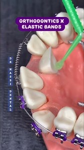 ORTHODONTICS PREPARATION X COLORFUL ELASTIC BANDS 🤩🦷