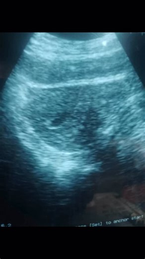 1. Retroverted uterus 2. The endometrium is midline with mild distended anaechoic intracavitary fluid. Impression: Mild ECF ? Cause (Patient’s clinical correlation advised) Differential diagnosis: Hematometra Endometritis #foryourpage❤️🔥🔥🔥✨😘❤️ #followforfollowback #ultrasound #ultrasoundscan | SirEric Ayofe Fellas