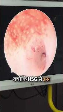 Doing IUI again and again? Watch this!