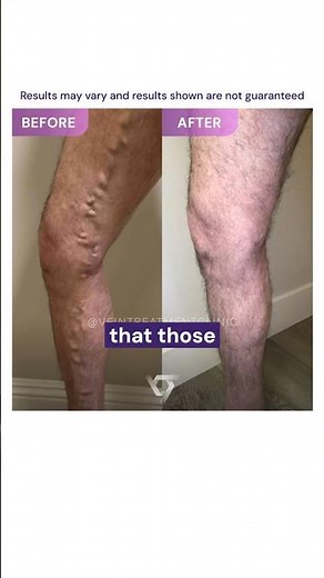 How common is chronic venous insufficiency?