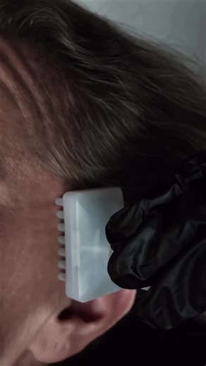 Not every scalp responds the same way to Jet Plasma. That’s the beauty of it — the protocol can be shaped around what your scalp actually needs. Continuous mode delivers a steady flow of plasma. I’ll use this if there’s excess oil, buildup, or inflammation that needs to be calmed. Pulsed mode works differently — short bursts that reach deeper to stimulate the follicle itself, encouraging activity and growth. For someone with a dry scalp, we may skip continuous mode altogether to protect the barr