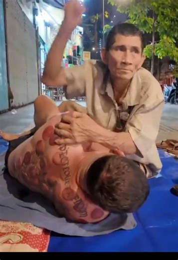 $5 Street Cupping Therapy in Vietnam: A Relaxing Experience