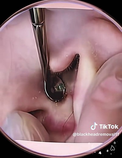 ‏Crazy blackhead in ear🥰🤩