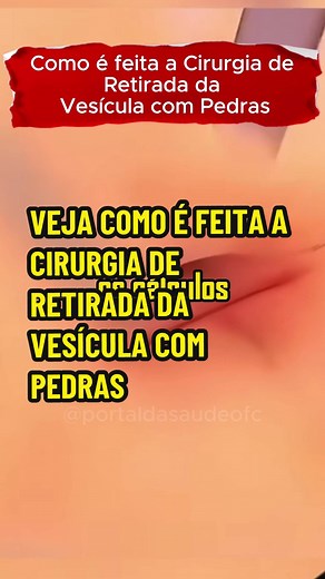 Cirurgia de Retirada da Vesícula: Passo a Passo