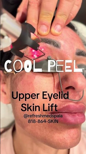 One way to tighten upper eyelid skin without surgery: #coolpeel #co2 #laser or #rf #rfmicroneedling