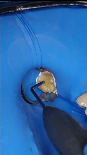 كيفية تطبيق ever x composite