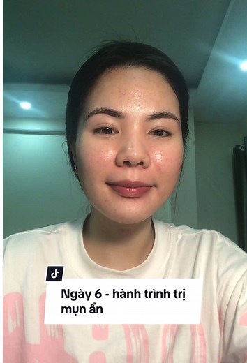 Ngày 6: hành trình trị mụn ẩn để #điềutrịmụn #trimun #skincare #mụn #beauty #trimuntainha #differin #mụnẩn
