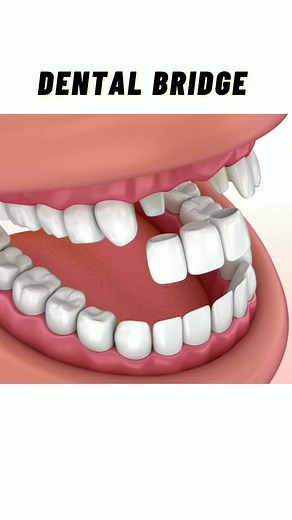 Dental Bridge | Dental Animation | Dental Daily