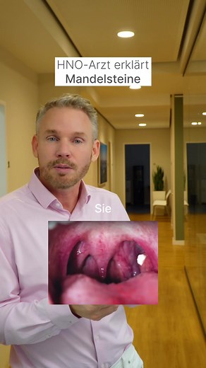 Mandelsteine: Ursachen, Behandlung und Tipps zur Entfernung