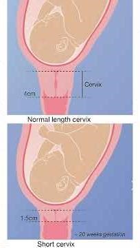 🤰 Loss of Pregnancy between 3 to 6 months? Pre-term Delivery? 🤱