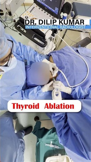Thyroid Nodule Treatment Without Surgery | Radiofrequency Ablation (RFA)